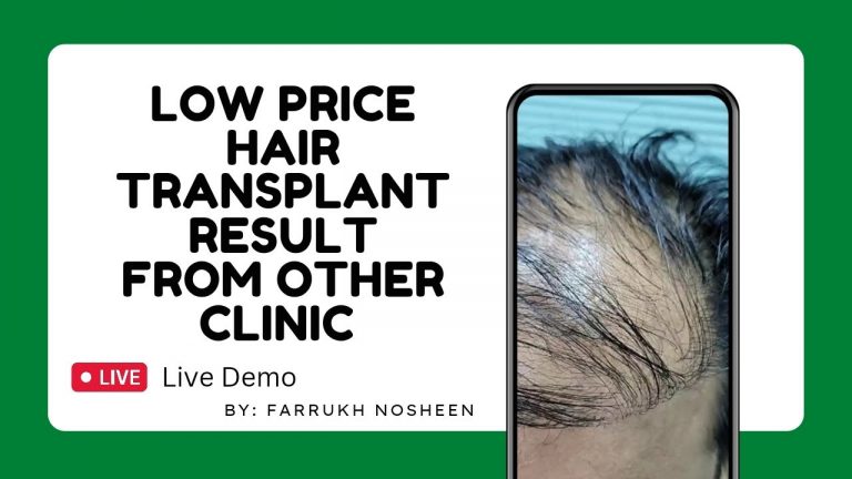 Low Price Hair Transplant From Other Clinic | Result | #fue #hairtransplant